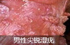 ʲôͷ(HPV)-lni