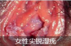 ʲôͷ(HPV)-lni