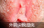 ʲôͷ(HPV)-lni