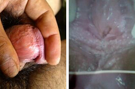 潜伏期人乳头病毒的症状有什么?-lni