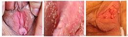 ͷ(HPV)κ-lni