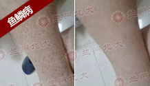 鱼鳞病难自愈 日常预防很重要-lni