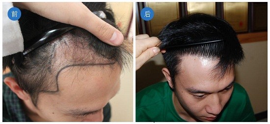 脱发应该如何调理 兰州北大植发科-lni